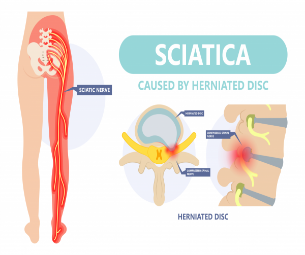sciatica