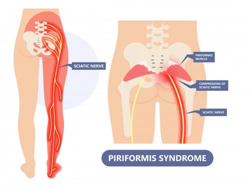 piriformis